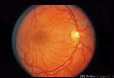 Normal Retina Retina Image Bank