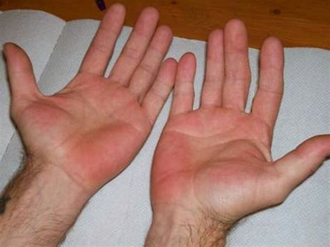 Pin By Great Wolf On Cirrhosis Excessive Hand Sweating Itchy Hands