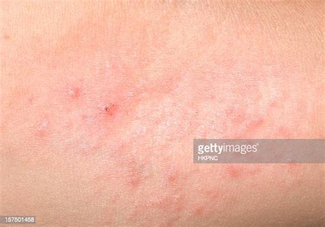 Nettle Rash Photos Stock Photos And Pictures Getty Images