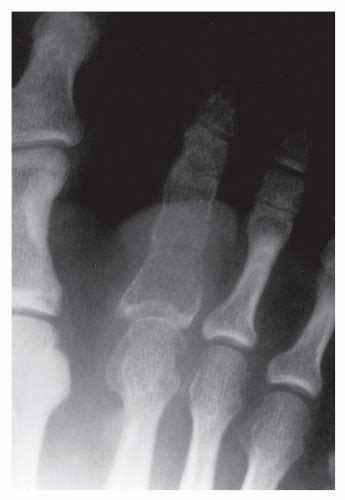 Bone Tumors Of The Foot And Ankle Musculoskeletal Key