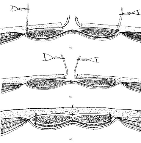 Figure 1 From Percutaneous Mesh Expansion And Fixation At The Retro