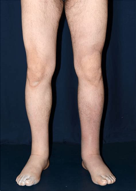 Bilateral Lower Limb Lymphedema Involving The Feet Ankles And Calves
