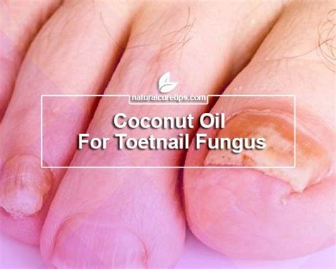 It makes because this plant has numerous wonderful properties that will have a positive impact on your body. Coconut Oil Nail Fungus Inspirational 10 Ways to Use ...