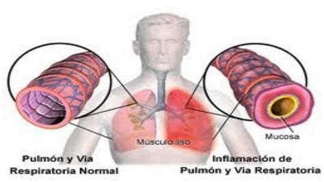 Bronquitis Aguda Y Cr Nica S Ntomas Causas Y Tratamiento Sexiz Pix