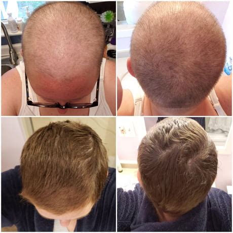 Months Of Hair Growth After Chemo Worth To Watch