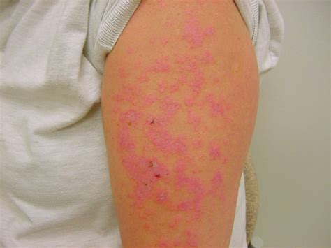 Lupus Erythematosus Discoid Diseases And Conditions 5minuteconsult