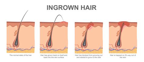 What Is An Ingrown Hair And How To Treat Them Kelowna Esthetics