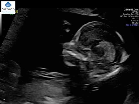 Anatomy Ultrasound Maternal Fetal Associates Of The Mid Atlantic