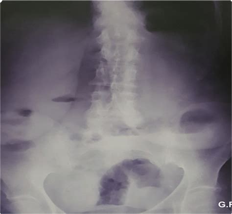 Plain Abdominal X Ray Showing Air Fluid Levels With Air In The Rectum