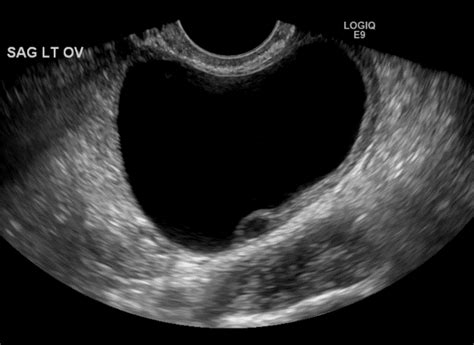 Guidance For The Diagnosis And Management Of Ovarian Cysts Clinical