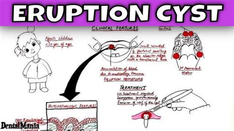 Eruption Cyst Pathogenesis Clinical And Histopathologic Features