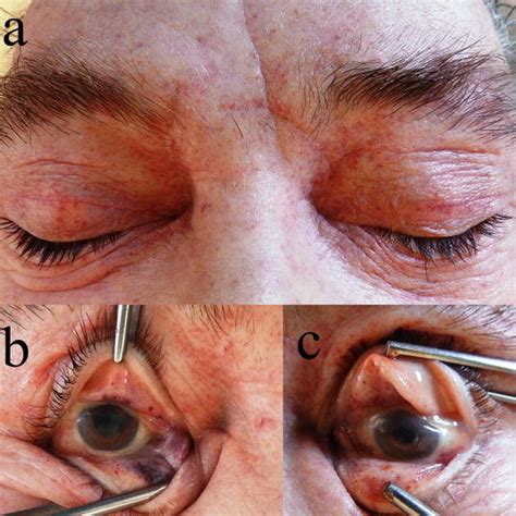 Trout Phenomenon Petechiae On The Eyelids And Skin Of The Forehead