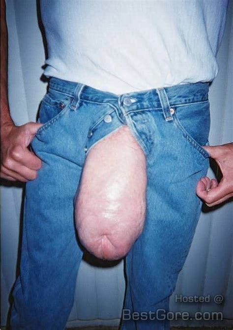 Penis Disproportionally Enlarged With Silicone Injections