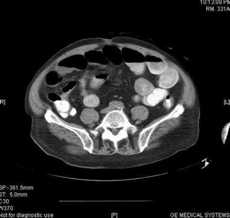 Abdominal Ct Scan With Intravenous Contrast Showed Mild Ascites And