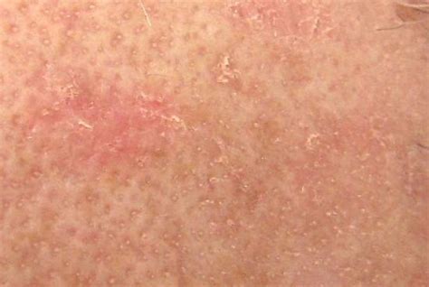 Scaling Skin Pictures Causes Treatment And Prevention