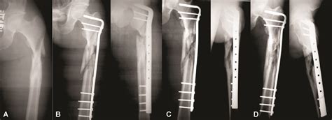 Minimally Invasive Plate Osteosynthesis Mipo In Long Bone Fractures