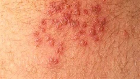 Rash Under Armpit Red Painful From Hiv Stds Candida Itchy Get Rid