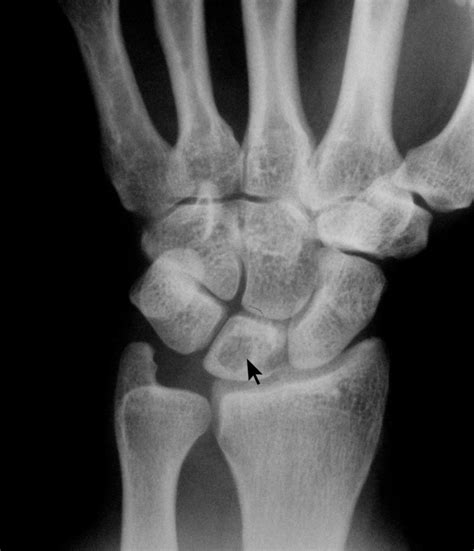 Unicameral Bone Cyst Of The Lunate In An Adult Case Report Journal Of Orthopaedic Surgery And