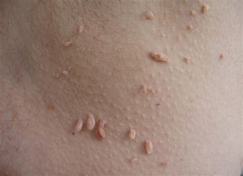 Natural Remedies For Common Skin Problems Warts Dark Spots