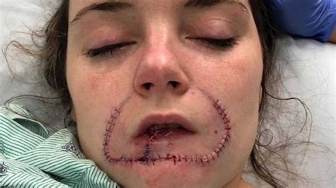 Overall prognosis for black widow spider bites is good in dogs. 'He claimed he was going to leave his mark on me for my ...