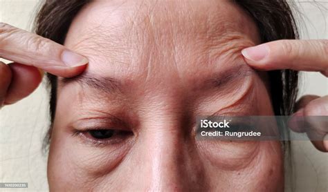 The Flabby Sagging And Wrinkles On The Face Stock Photo Download