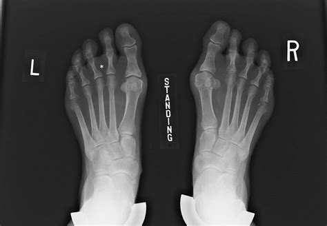 Plantar Plate Injury And Angular Toe Deformity Foot And Ankle Clinics
