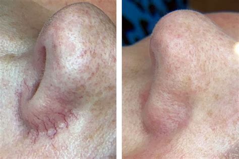 Advanced Electrolysis Wart Removal Pure Perfection