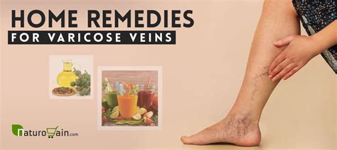 10 Safe And Best Home Remedies For Varicose Veins