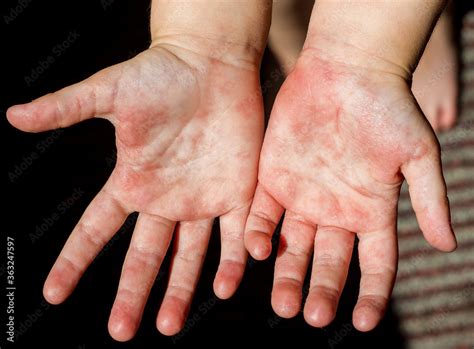 Red Rash On The Hands Of The Palms Of The Child Rubella Scarlet Fever