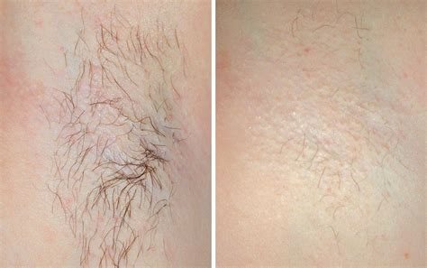 Laser Hair Removal Cheshire Renew Medical Aesthetics