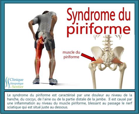 Le Syndrome Du Piriforme Nerf Sciatique Syndrome Pyramidal Clinique