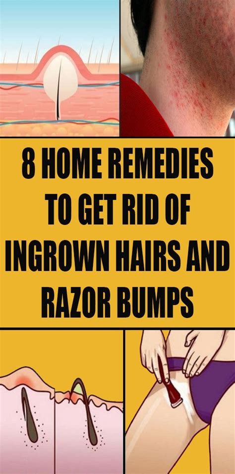 Use acid the cure for ingrown hairs is exfoliation. 8 Home Remedies to Get Rid of Ingrown Hairs and Razor ...