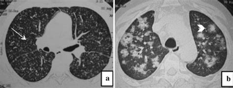 Fungal Pneumonia A Chest Ct Shows The Presence Of Tiny Random Nodules