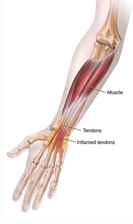 What are the bones in the forearm? Wrist Tendonitis, self treatment