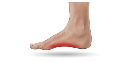 Articles Blog By Mass4d® Insoles Tagged Foot Conditions Mass4d