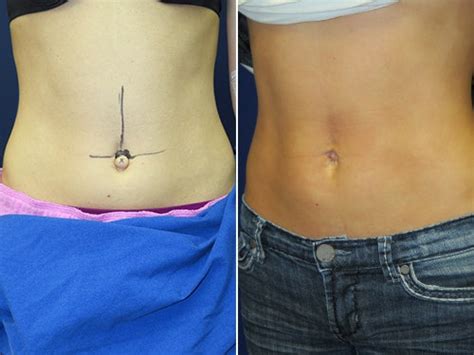 Cosmetic Belly Button Surgery Allure