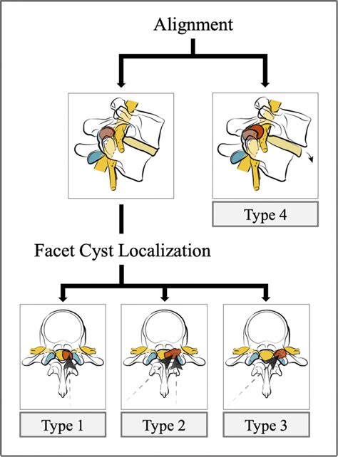 Classification Of The Facet Cysts And The Respective Suitable