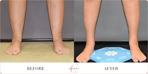 Knees Calves And Ankles Vaser Liposuction Before And After