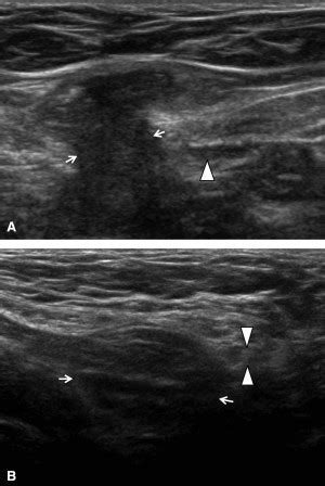 Inguinal triangle, medial of inferior epigastric vesselsindirect: A) Transverse sonogram of a left groin shows a direct ...