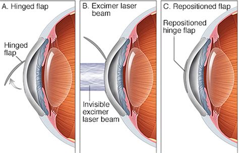 Hyperopia Farsighted Vision Causes Symptoms Diagnosis And Treatment