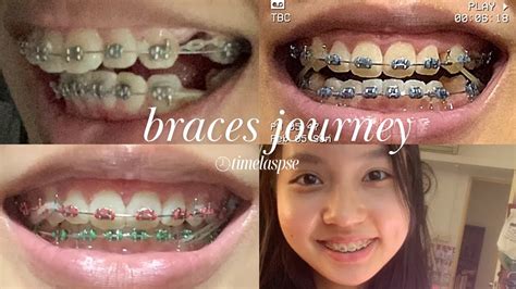Braces Overbite Time Lapse With Extractions Youtube