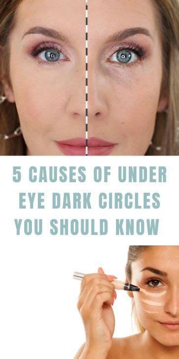 5 Causes Of Under Eye Dark Circles You Should Know Plus A Quick