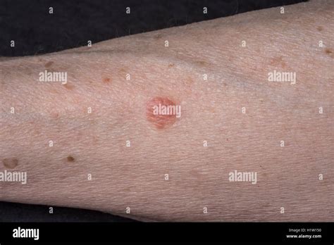 La kératose actinique lésion sur woman s arm Photo Stock Alamy