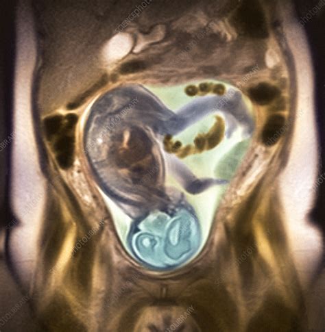 36 Week Foetus Mri Scan Stock Image P6800548 Science Photo Library