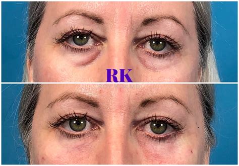 Lower Eyelid Rejuvenation How To Fix Under Eye Bags Roy Kim Md