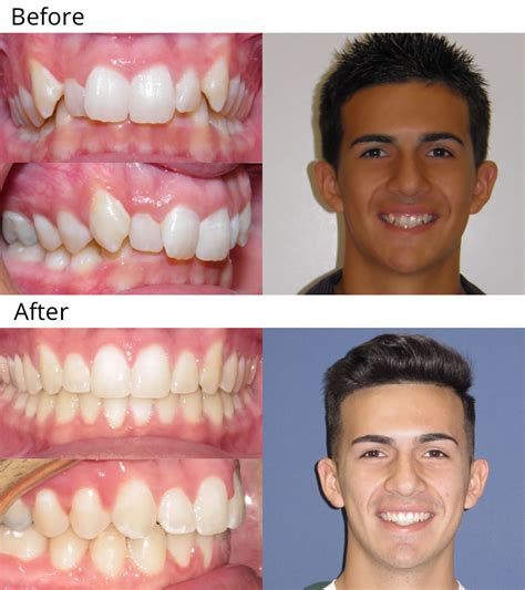 Braces Jaw Overbite Before And After Before And After Vrogue