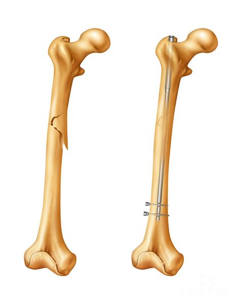 Femur Fracture And Repair Illustration Photograph By Gwen Shockey