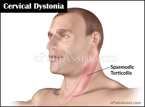 Treatment And Exercises For Cervical Dystonia Or Spasmodic Torticollis