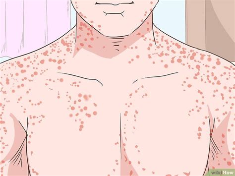 People with leukemia may notice tiny red spots on their skin — these pinpoints are called petechiae. Come Riconoscere i Sintomi della Leucemia: 12 Passaggi