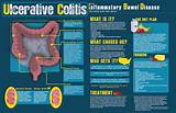Colitis Constipation Treatment